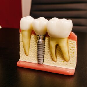 Close-up of a dental implant model on a professional workspace desk.